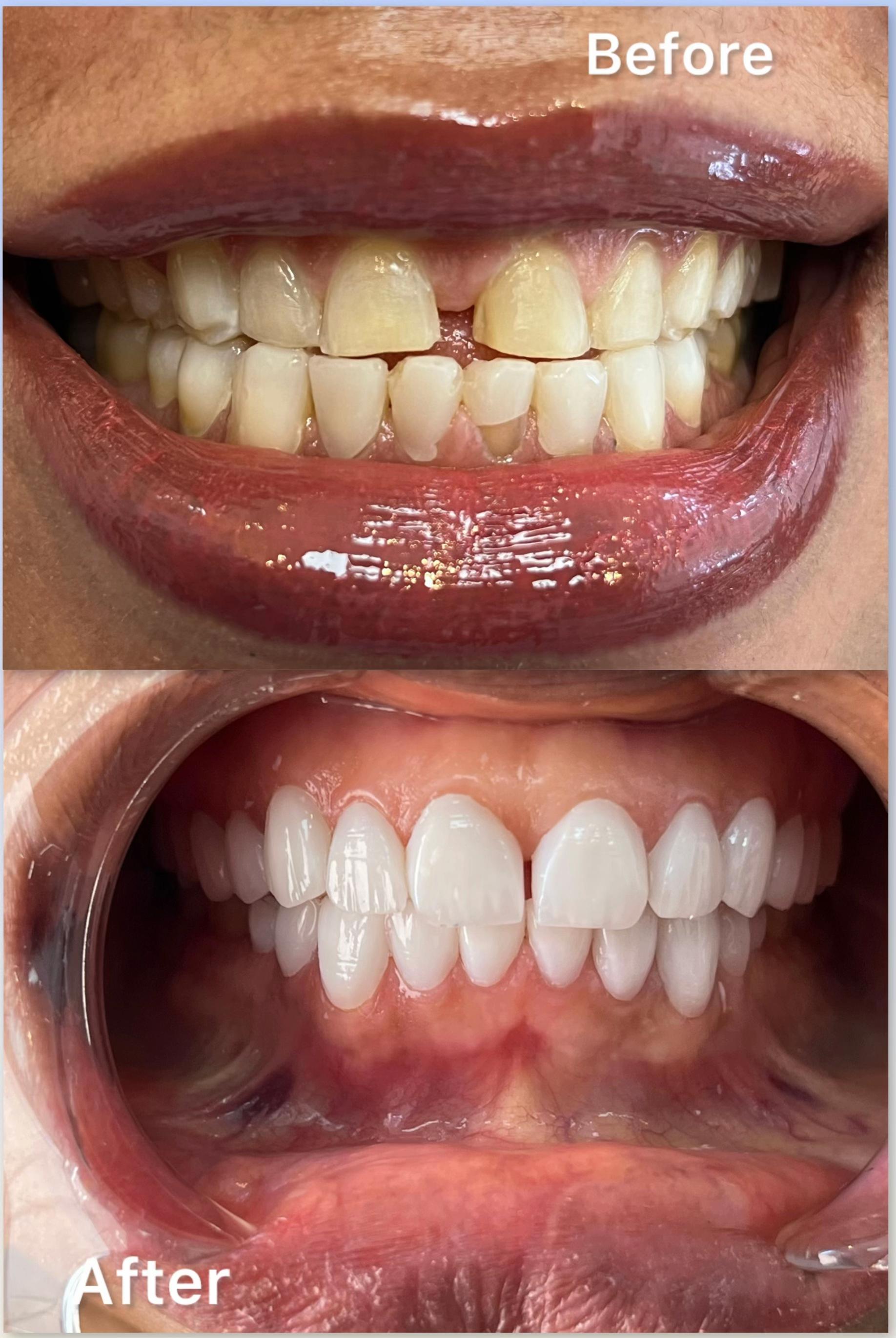 @Whiten Lighten TAC
