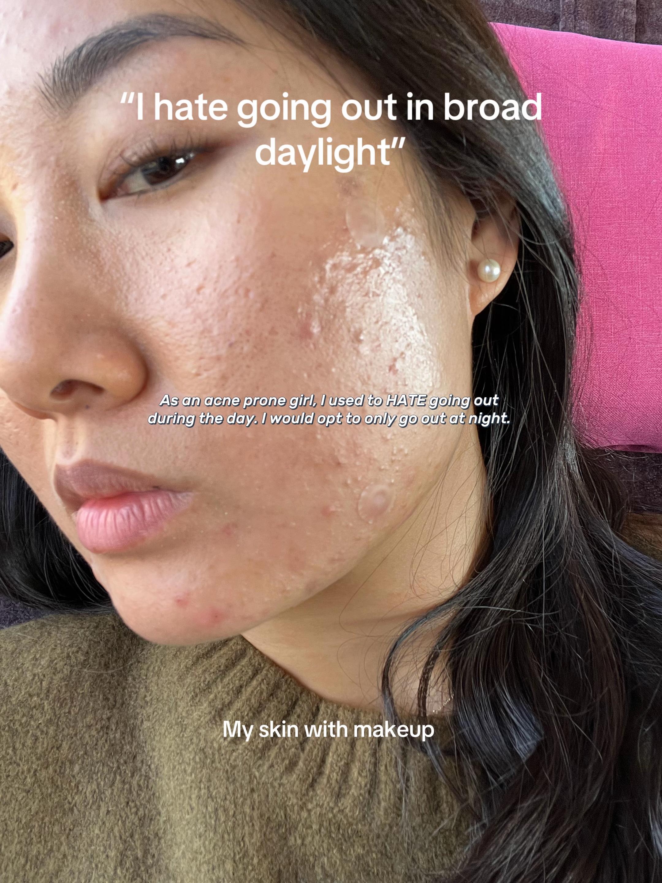 @Lisa | acne → clear skin