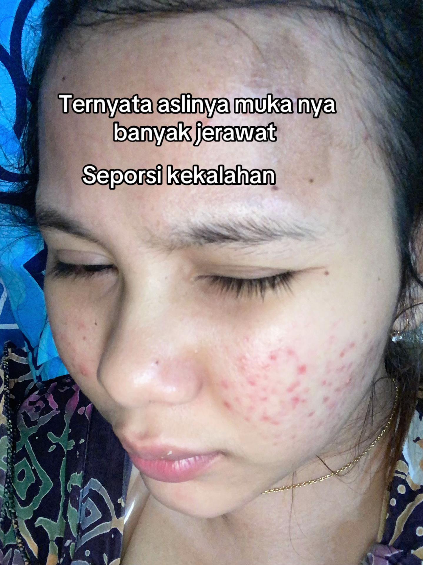 @Natha | Acne fighter
