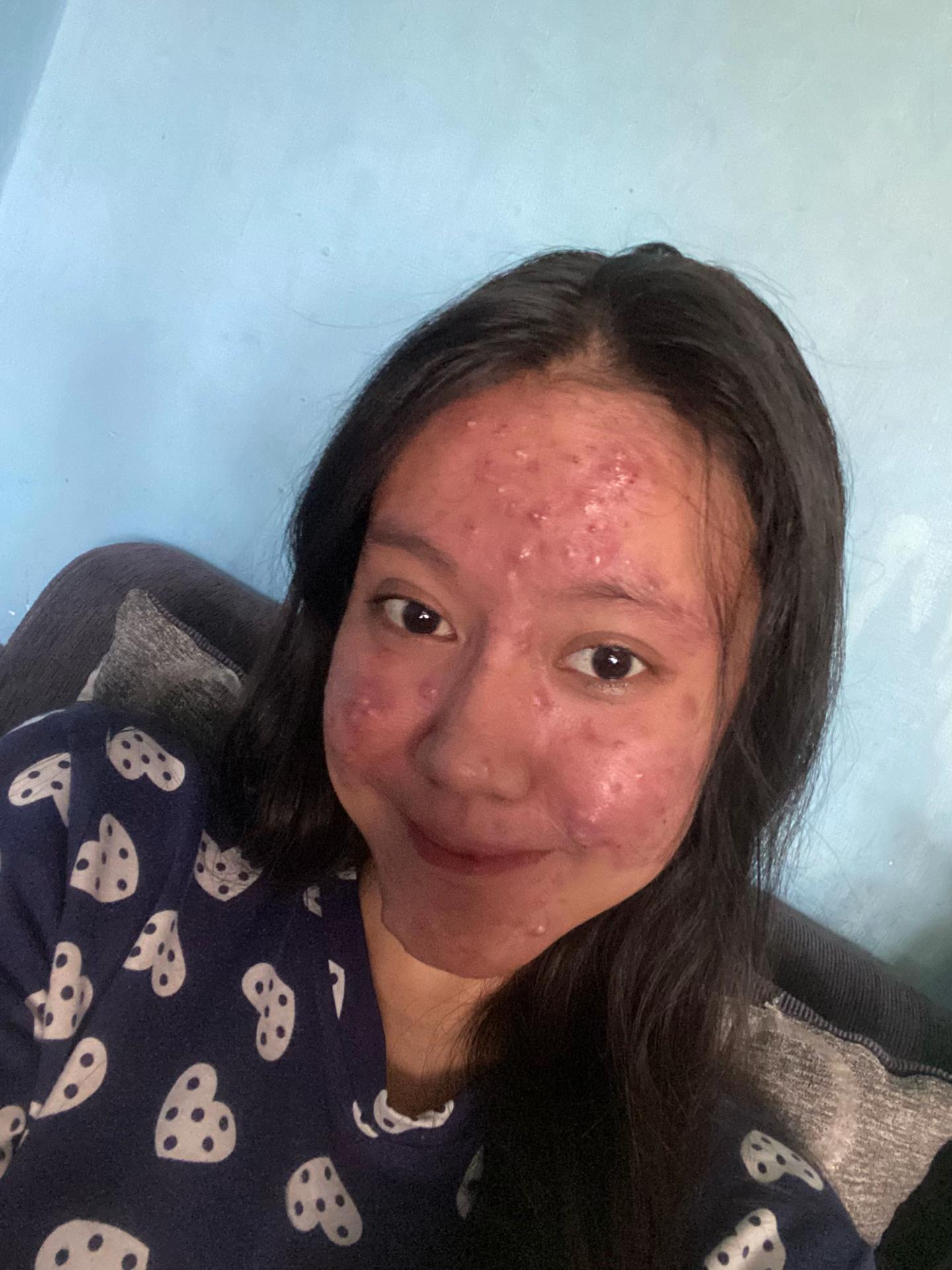 @Ichaa | acnefighter