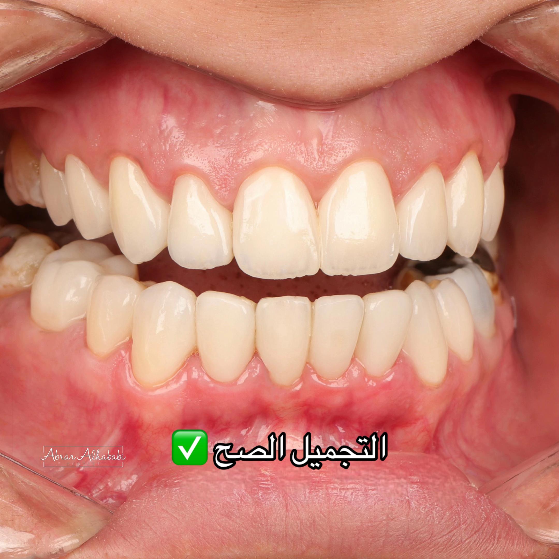 @Dr. Abrar Alhababi