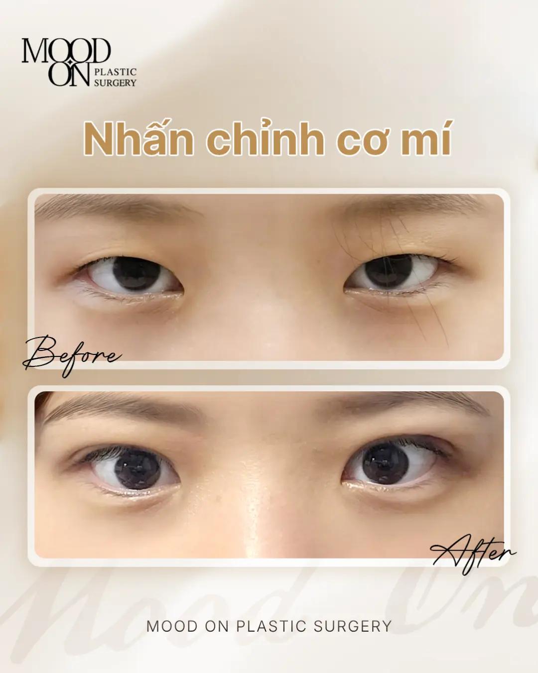 @Bệnh viện thẩm mỹ Mood On