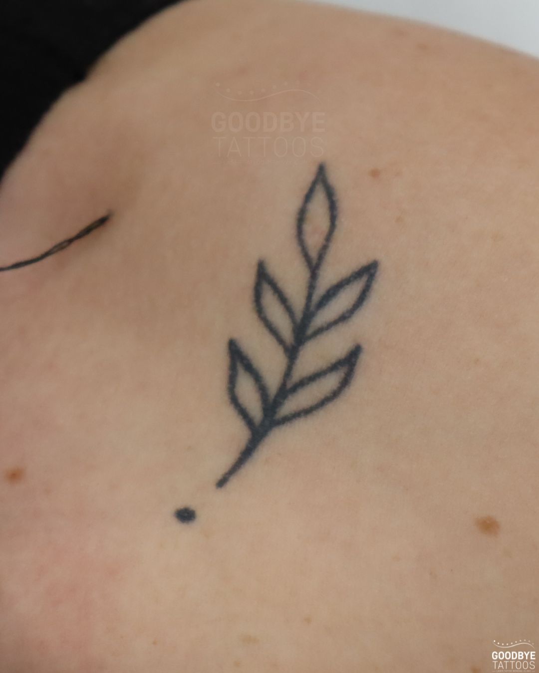 @Jamie T| Tattoo Removal Expert