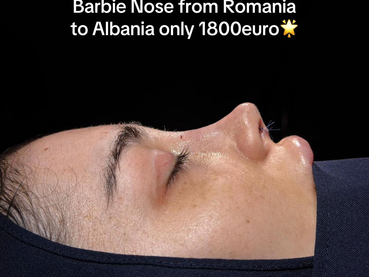 @rinoplasticatirana