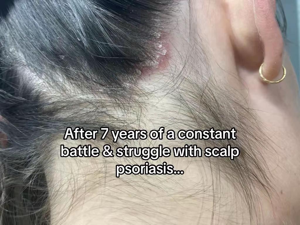 @Eczema Diaries USA & UK