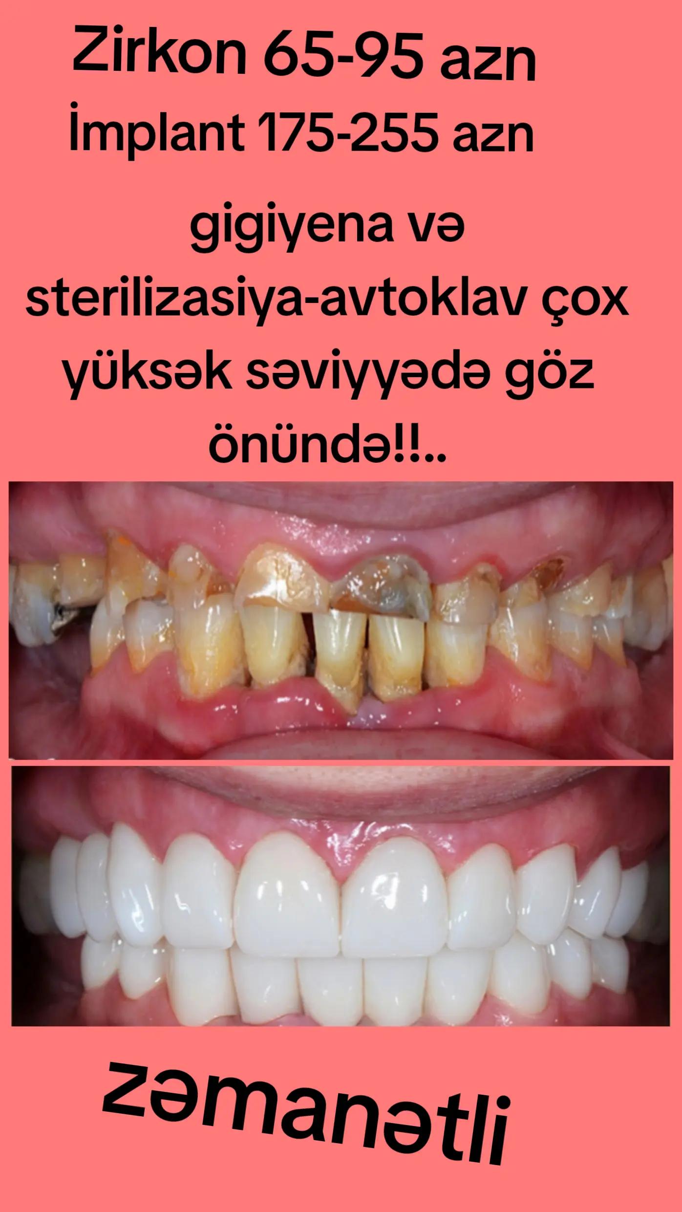 @implant.32