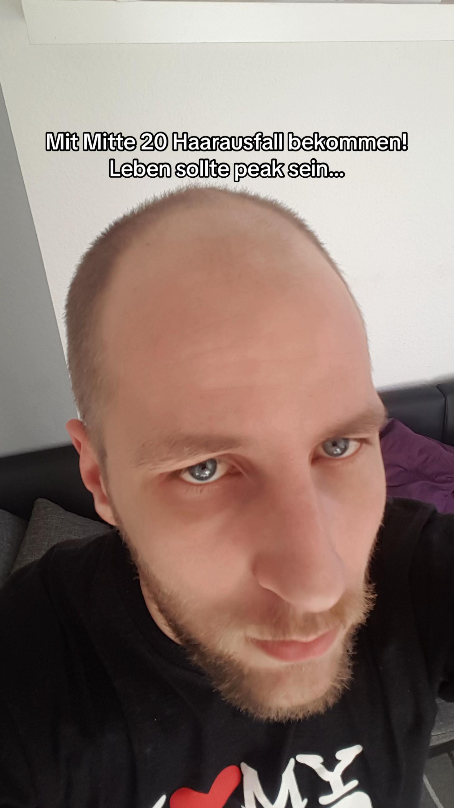 @Mr. Hairtransplant