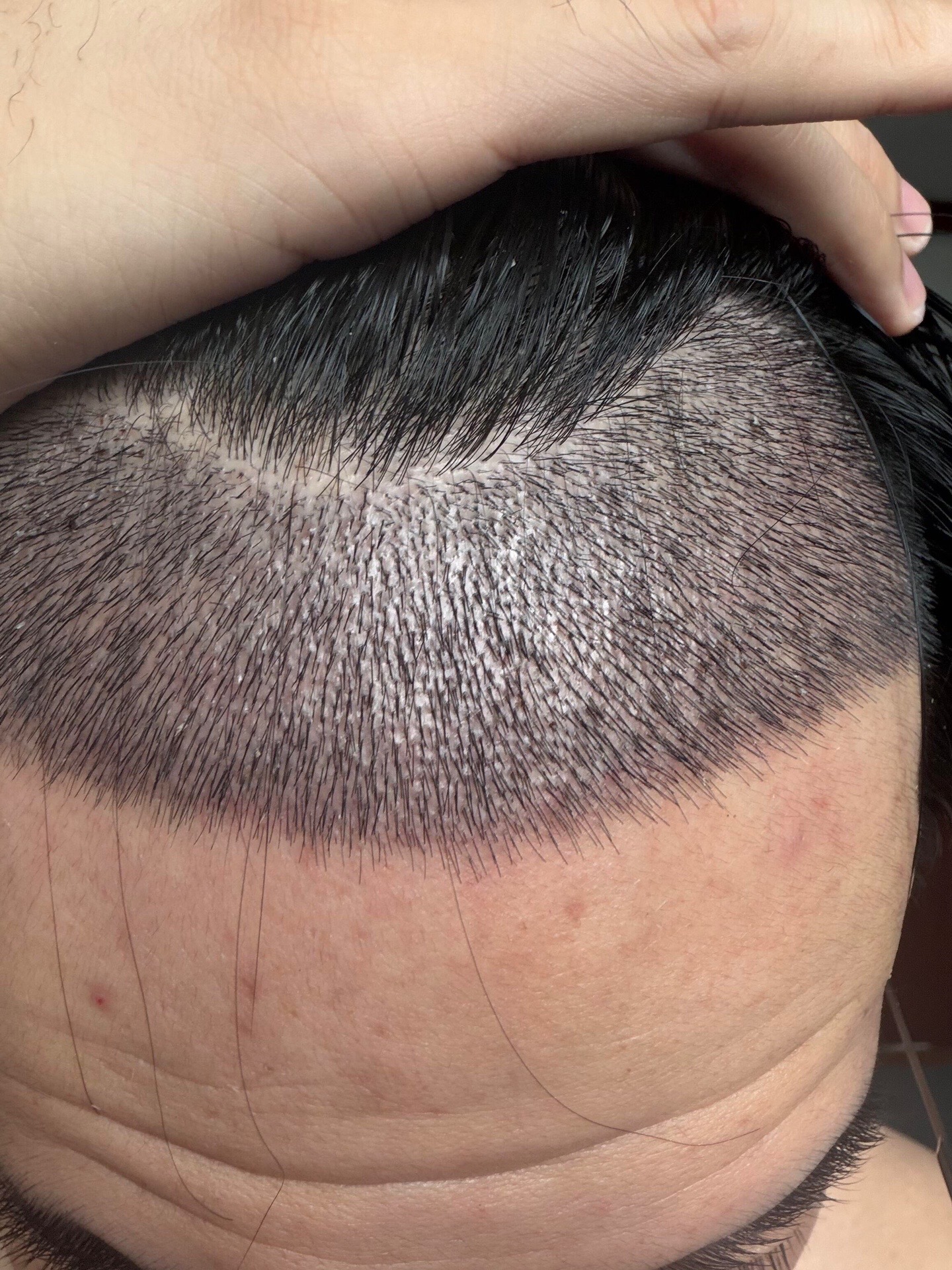 @HAIR TRANSPLANT WANG🇨🇳