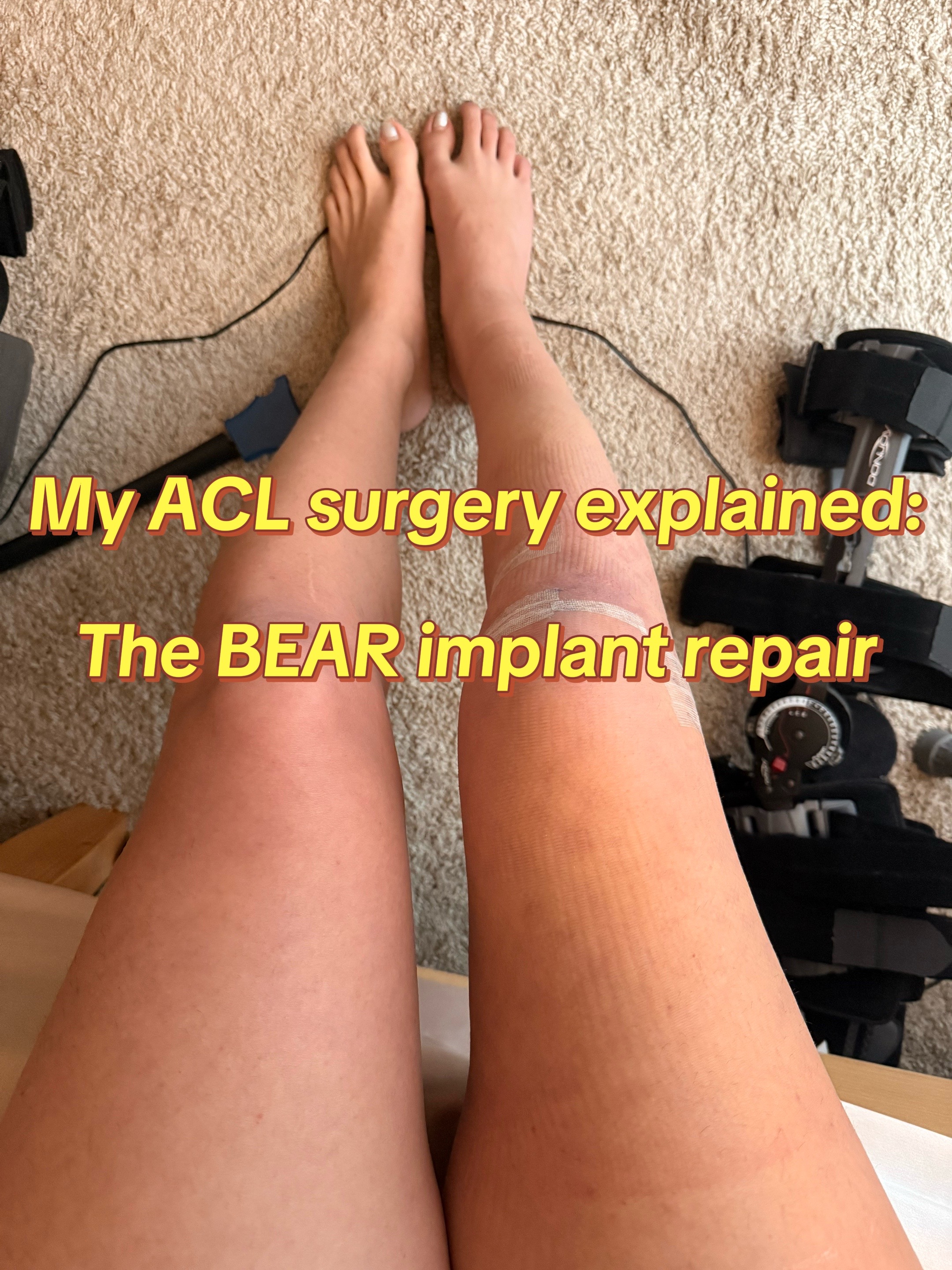 @Shelbs // ACL Recovery ❤️&zwj;🩹