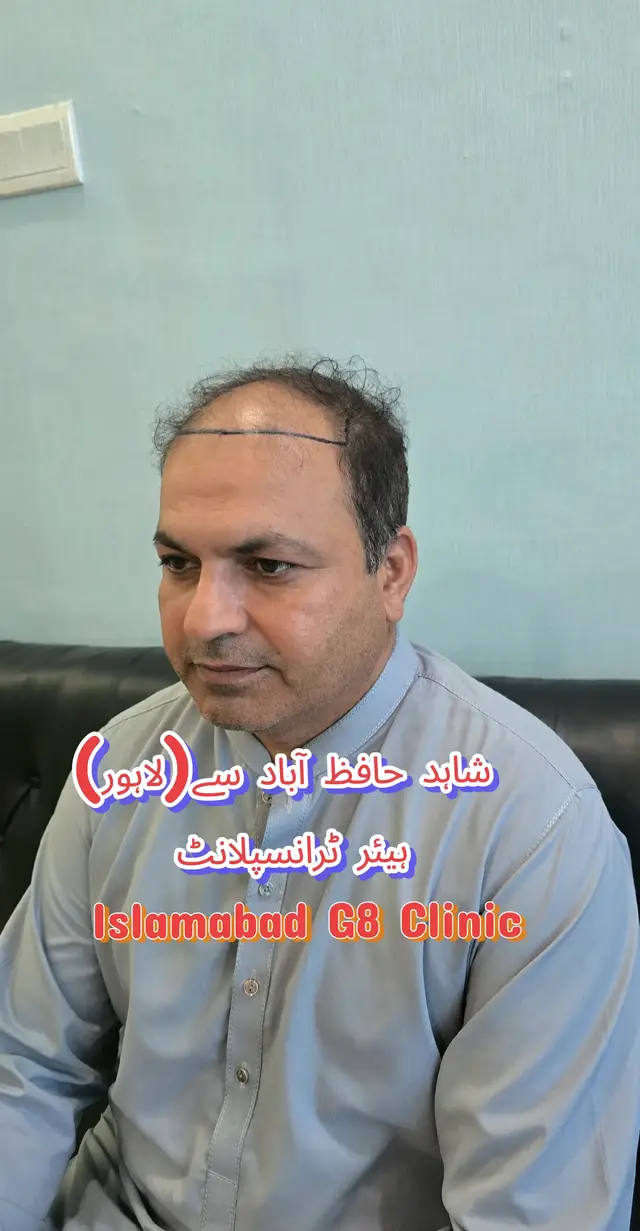 @Dr Asad shalman HairTransplant