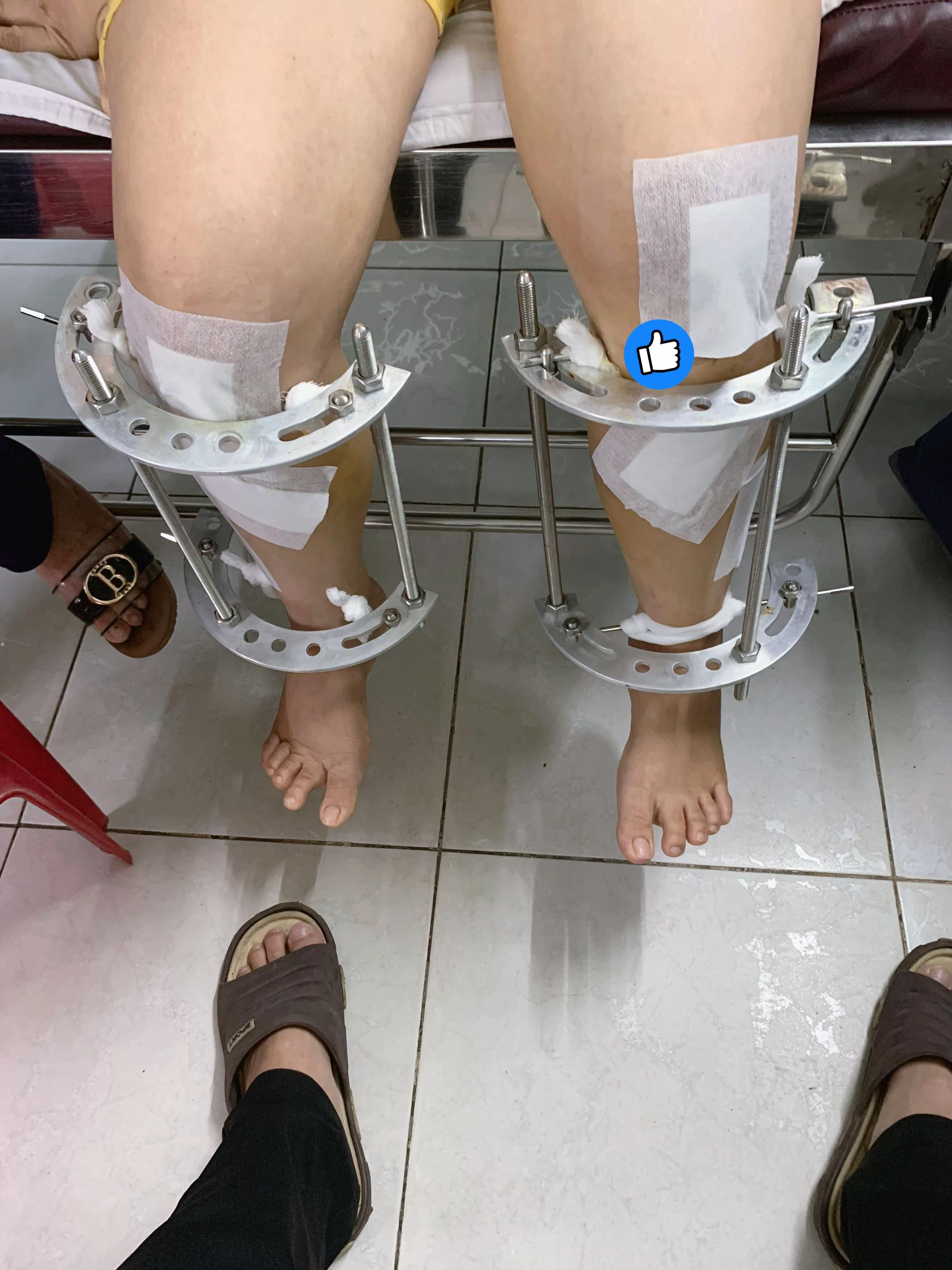 @K&eacute;o d&agrave;i ch&acirc;n TPHCM