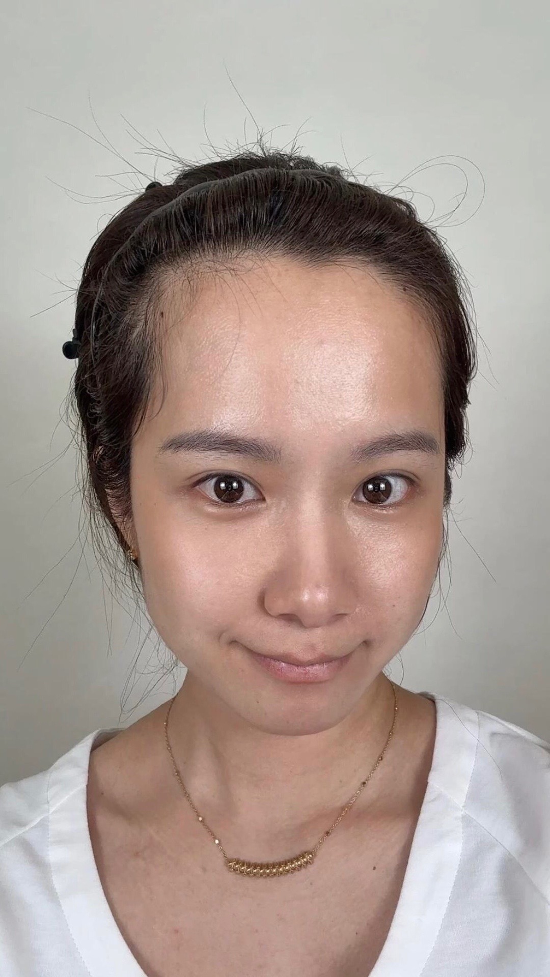 @HAIR TRANSPLANT WANG🇨🇳