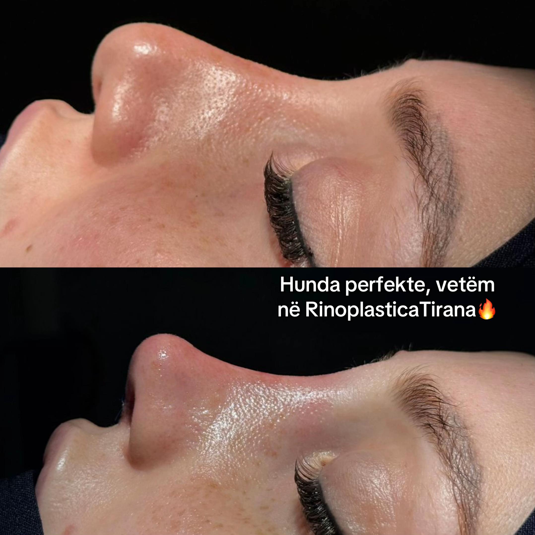 @rinoplasticatirana