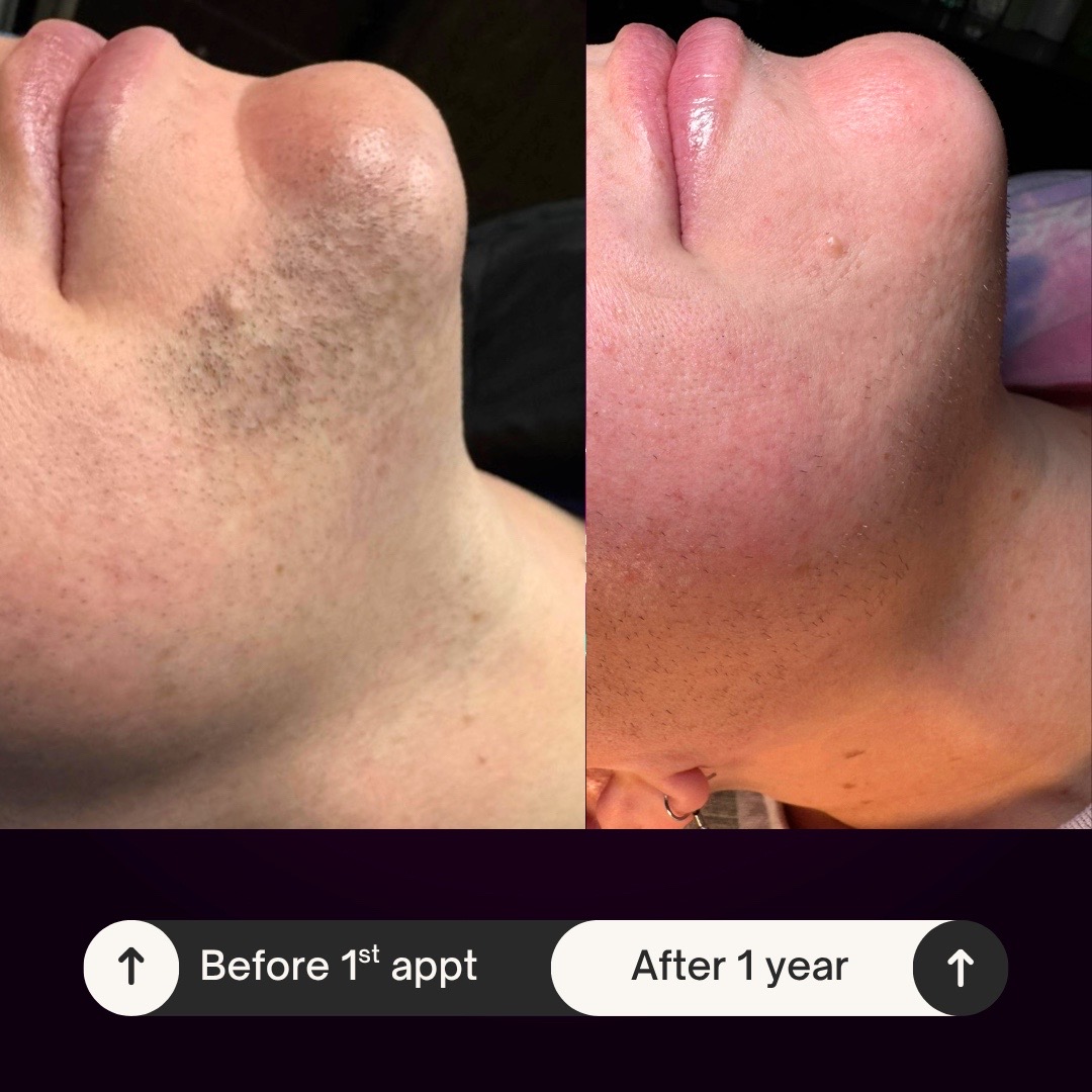 @Neurospice Beauty Electrolysis