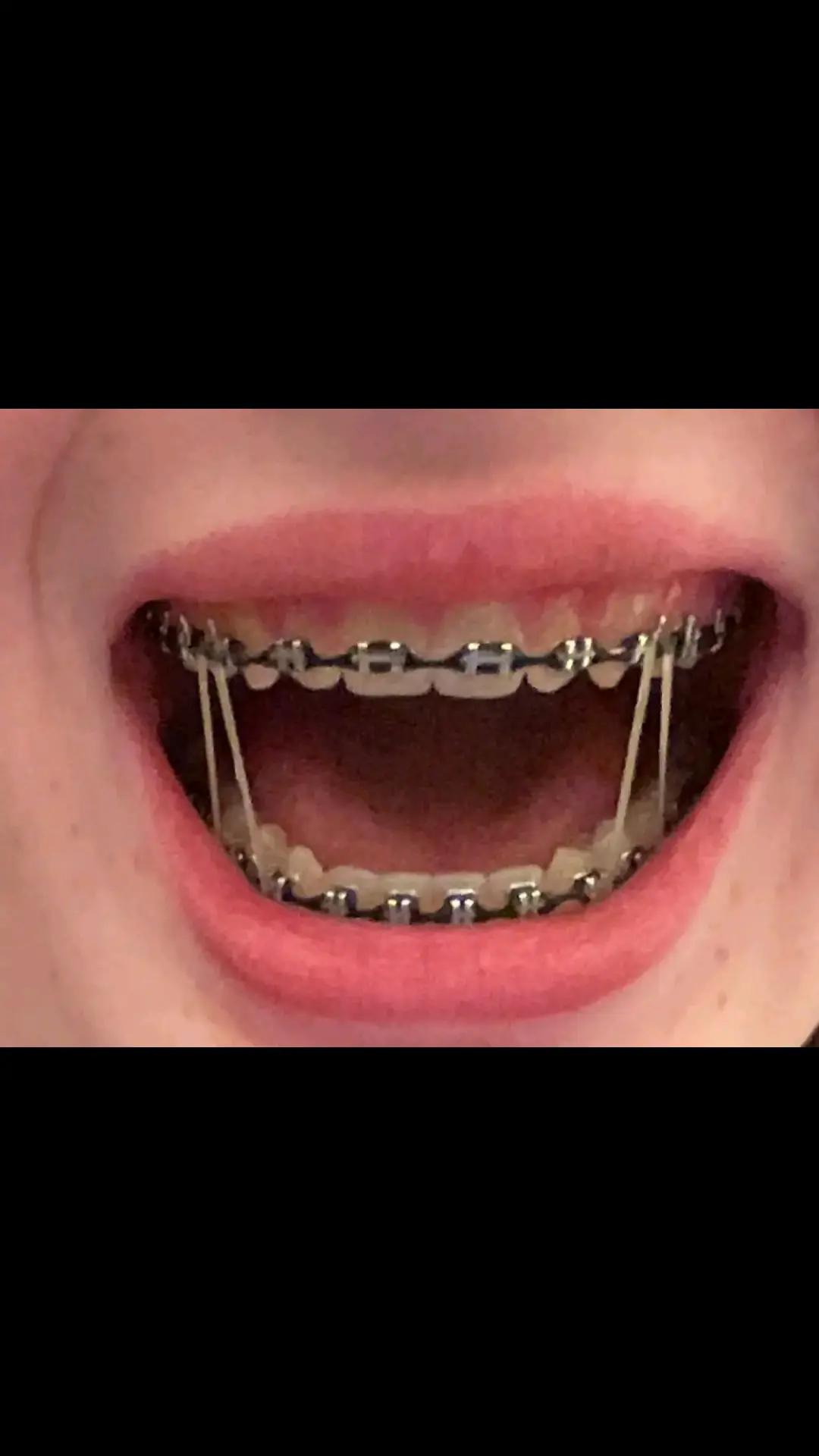 @Zahnspangen Club/  Braces Site