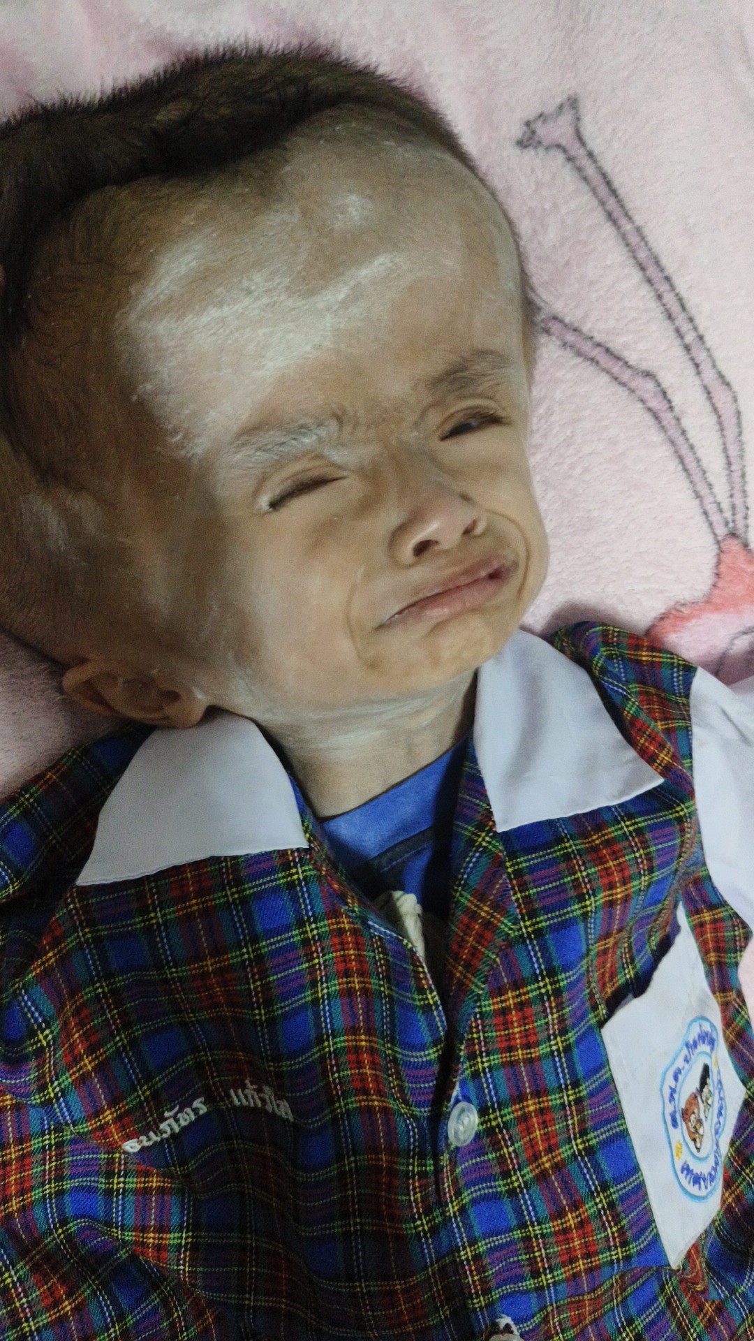 @บู้บี้เด็กหัวโตมีน้ำในโพรงสมอง