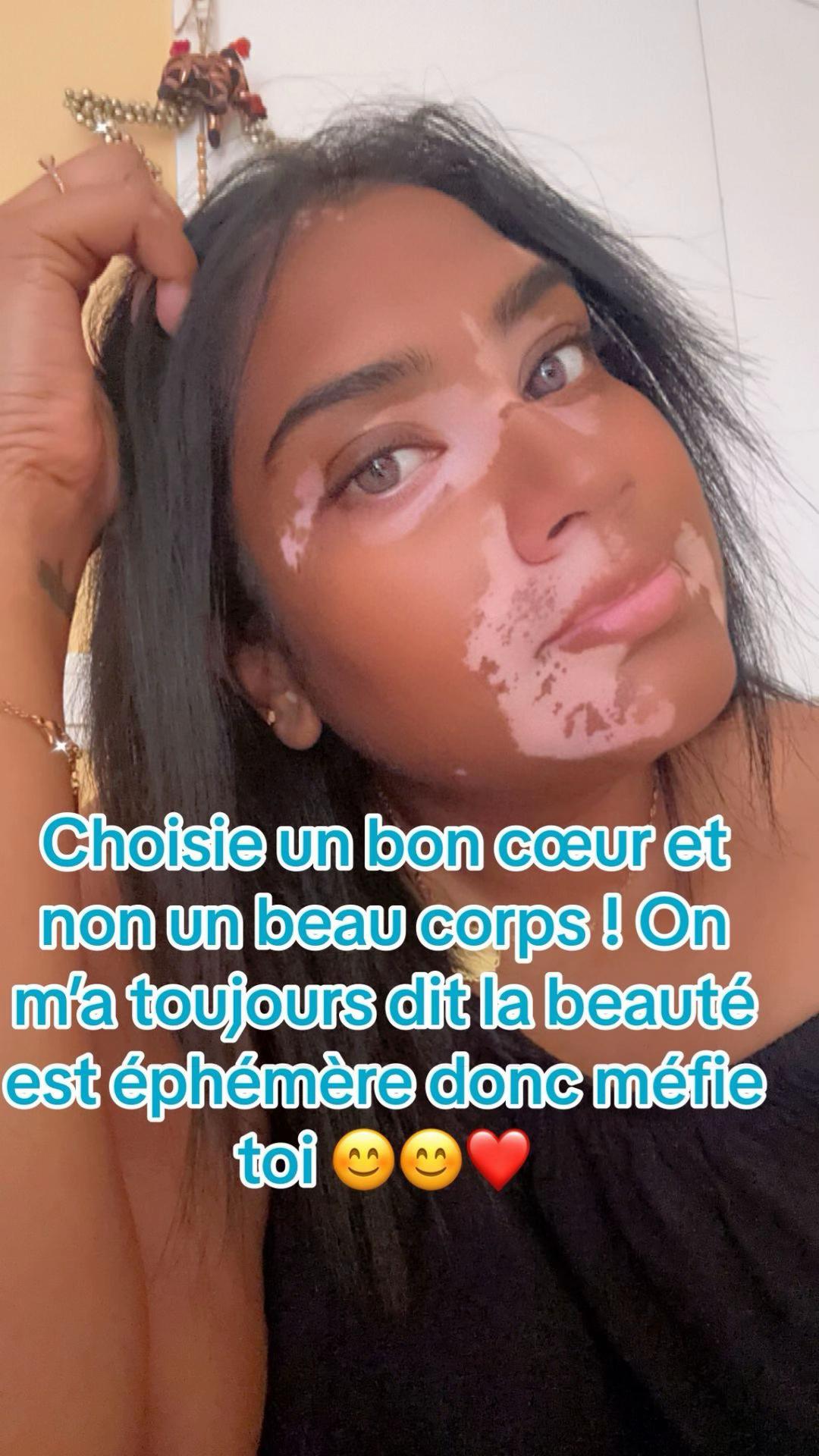 @Mimie | Vitiligo 🤍🌸