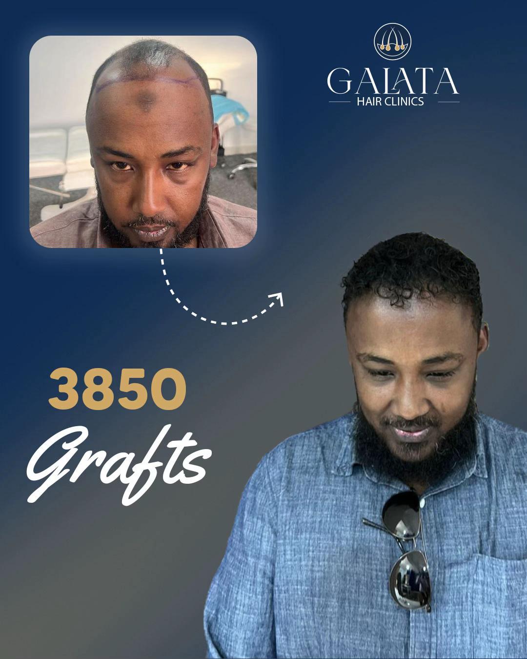@galata_hair_clinic