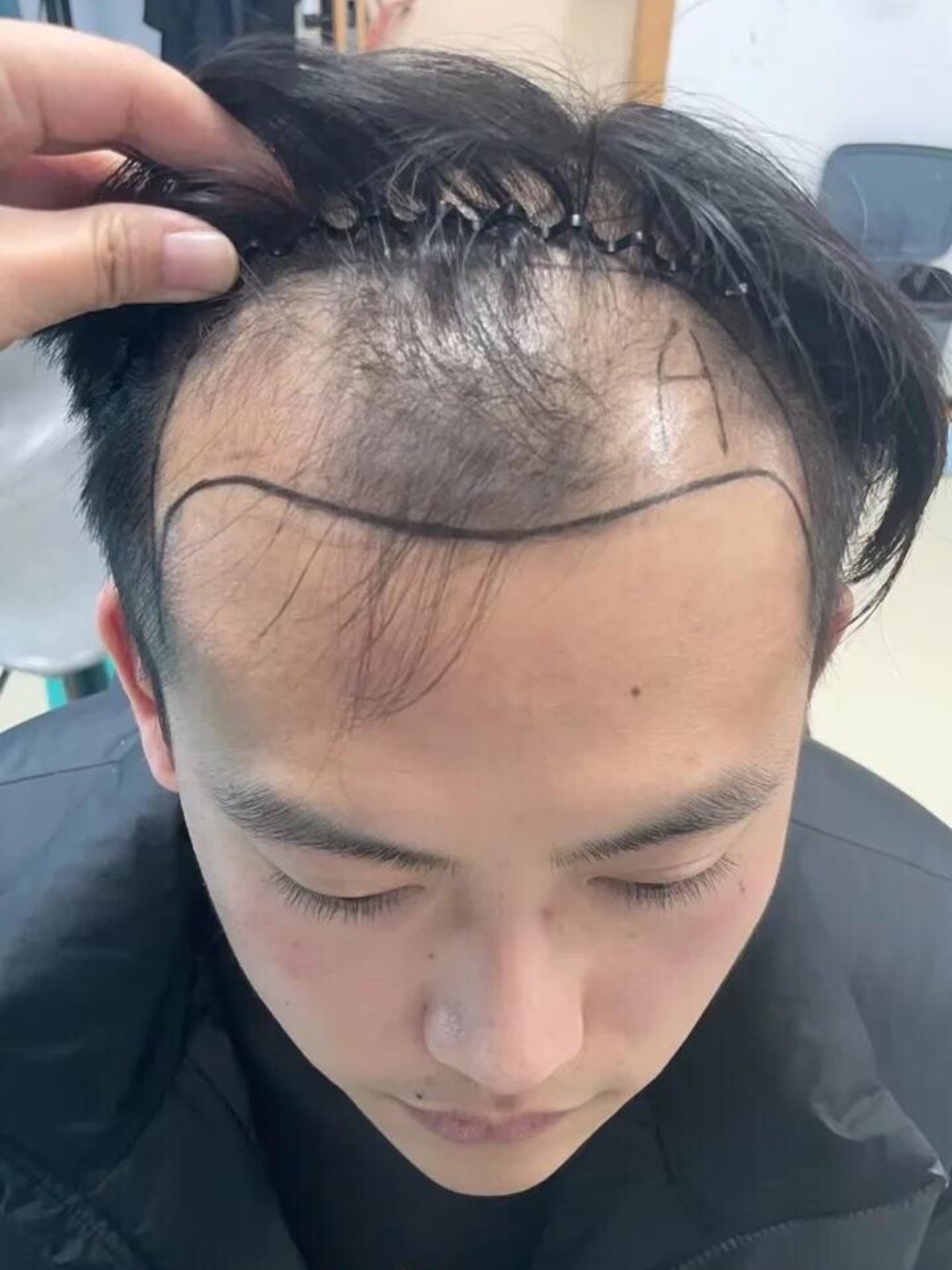 @HAIR TRANSPLANT WANG🇨🇳