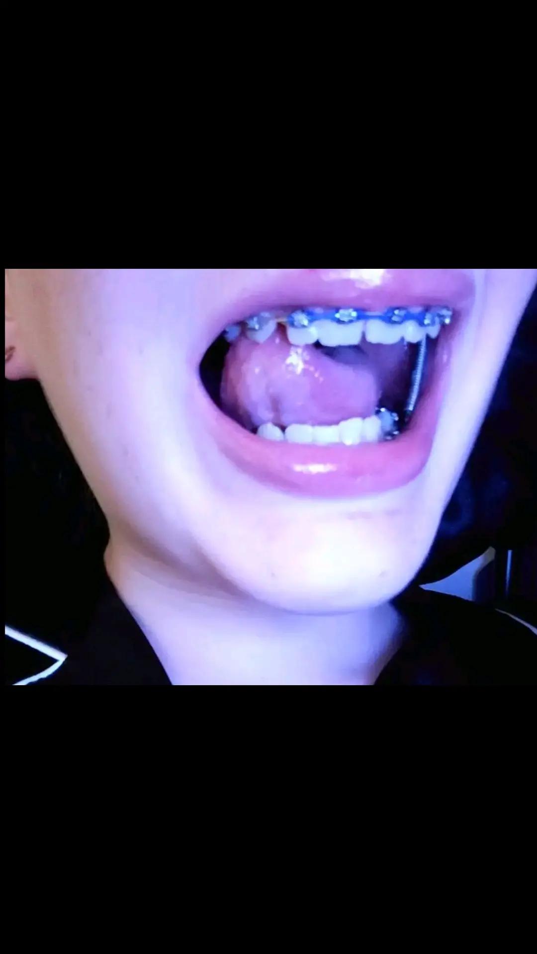 @Zahnspangen Club/  Braces Site