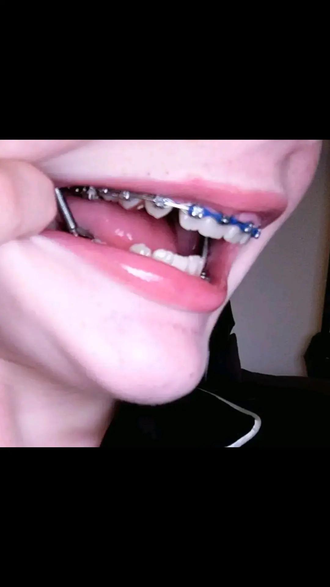 @Zahnspangen Club/  Braces Site