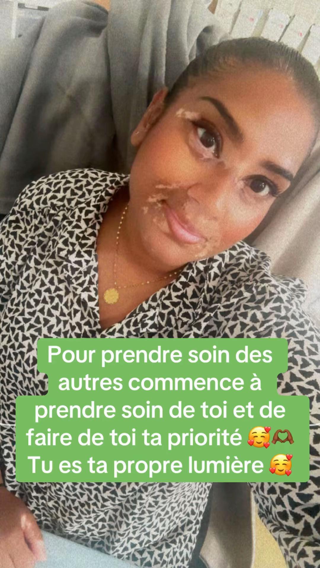 @Mimie | Vitiligo 🤍🌸