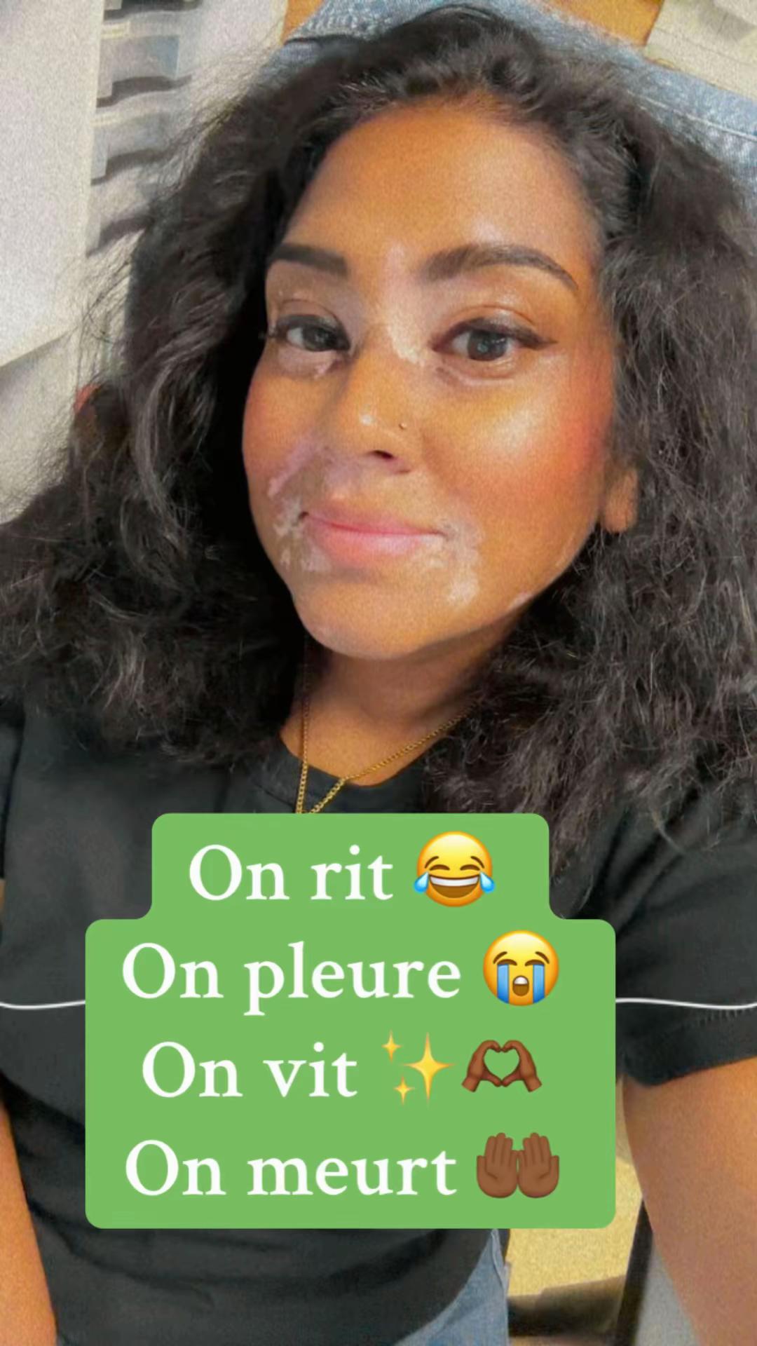 @Mimie | Vitiligo 🤍🌸