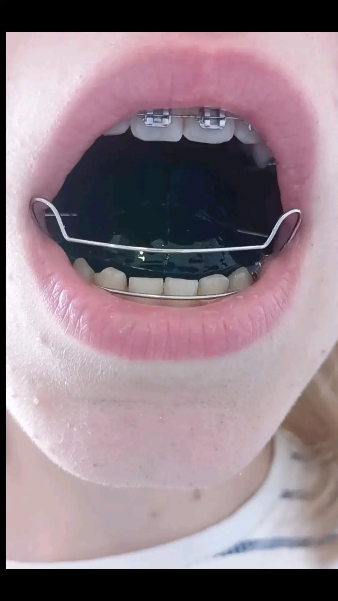@Zahnspangen Club/  Braces Site