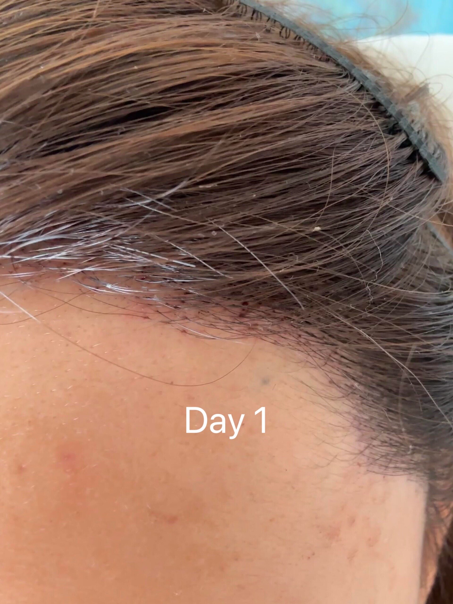 @HAIR TRANSPLANT WANG🇨🇳