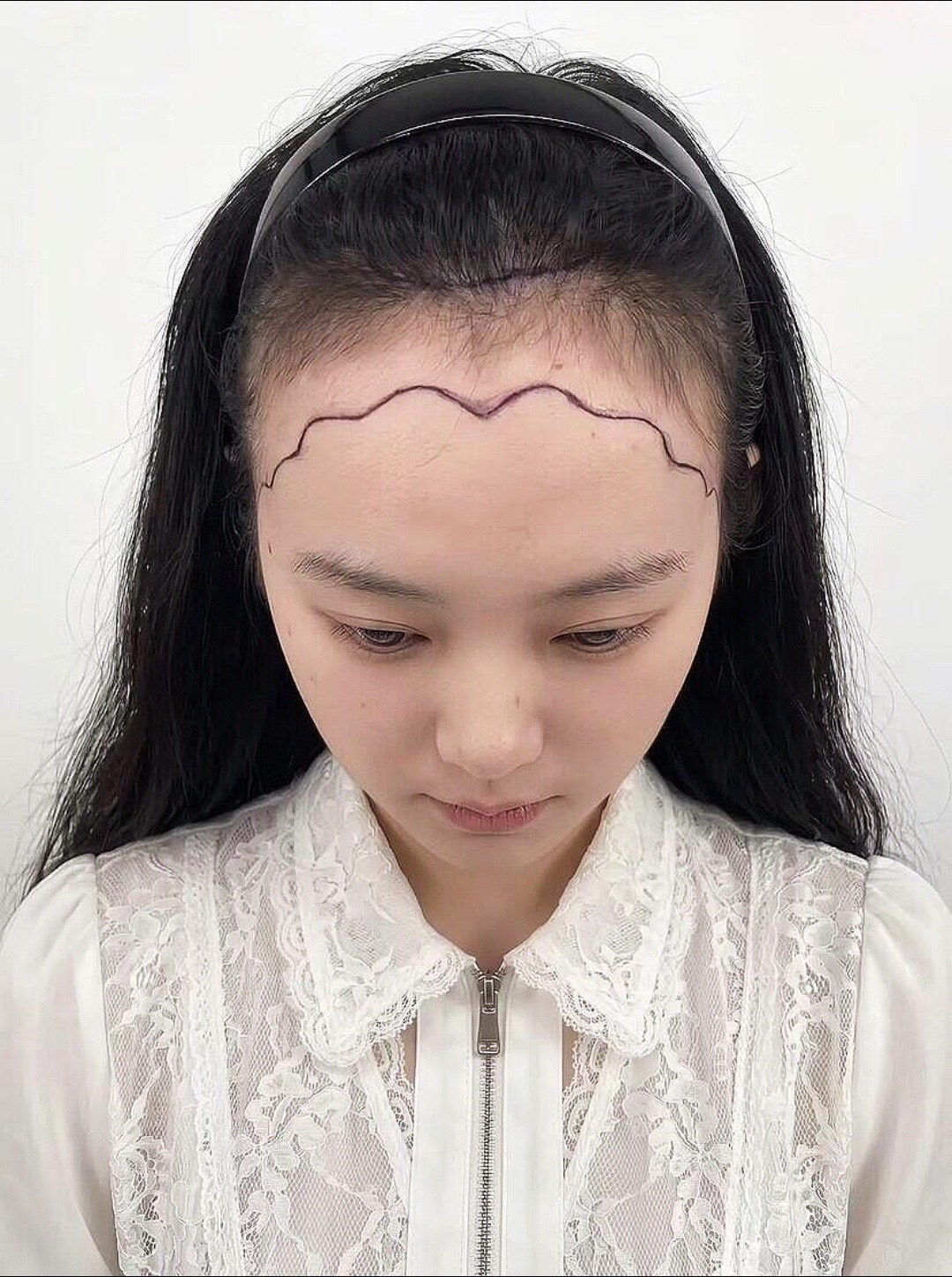 @HAIR TRANSPLANT WANG🇨🇳