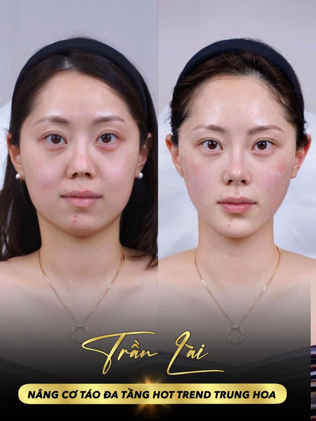 @Trần L&agrave;i 98