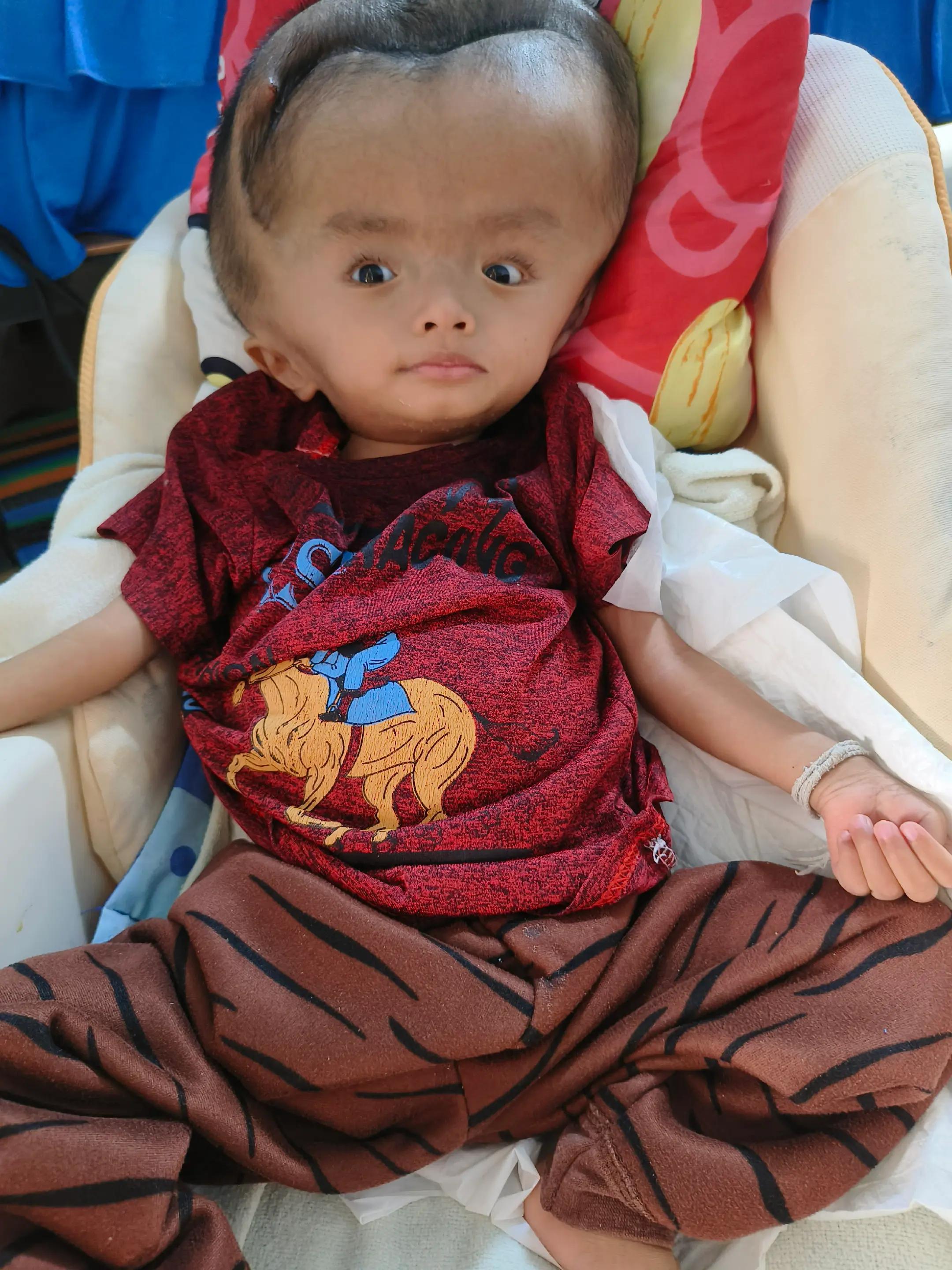 @บู้บี้เด็กหัวโตมีน้ำในโพรงสมอง