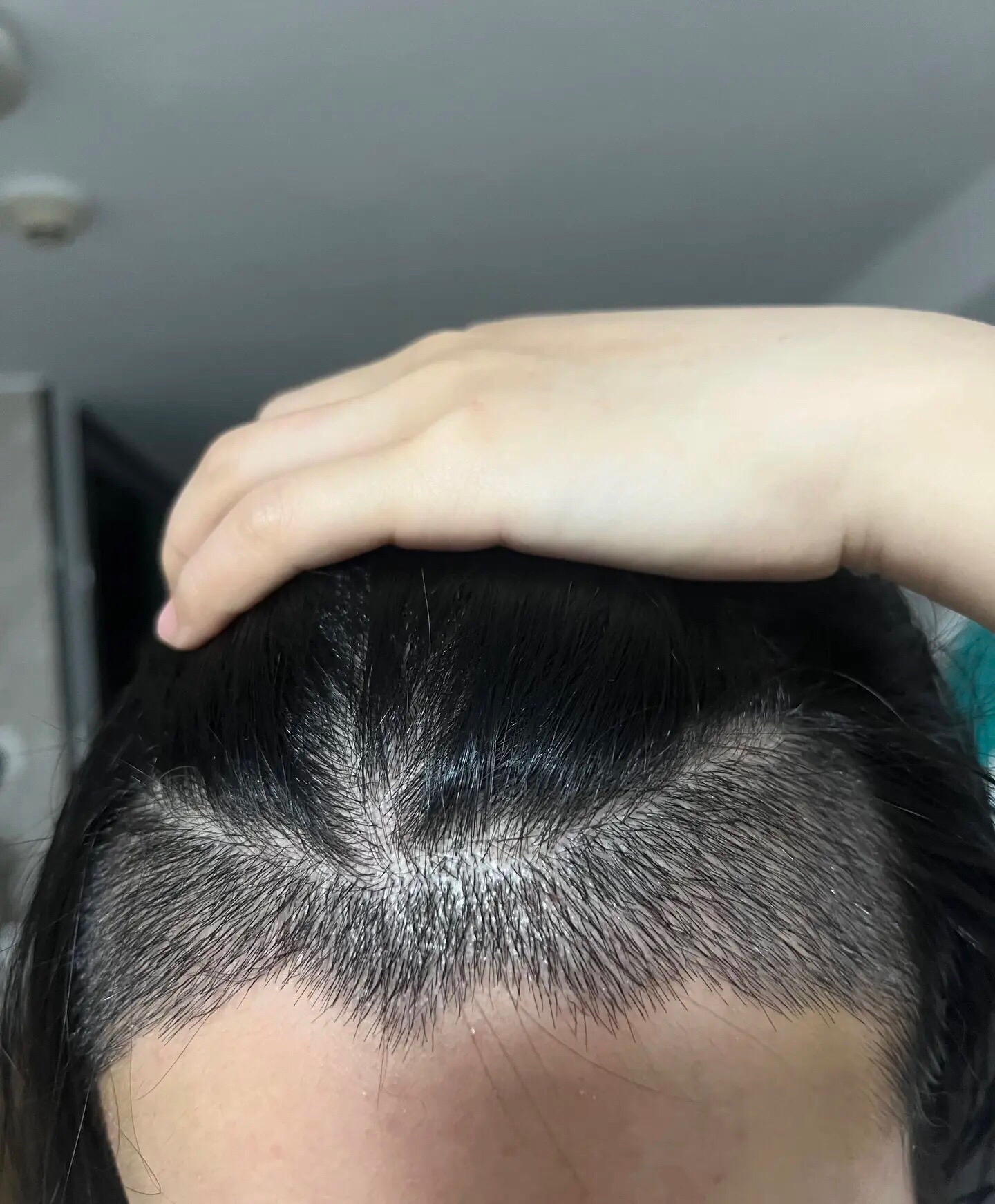 @HAIR TRANSPLANT WANG🇨🇳