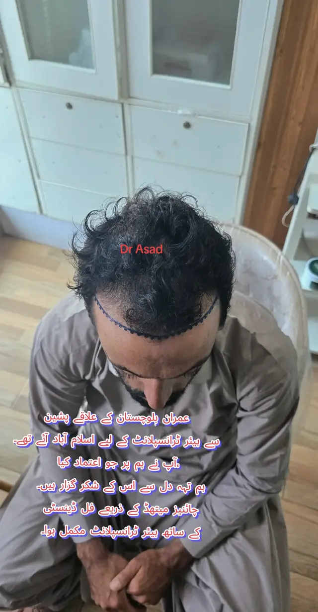 @Dr Asad shalman HairTransplant