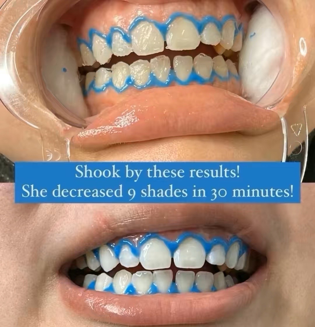 @Diandra | Teeth Whitening Tech