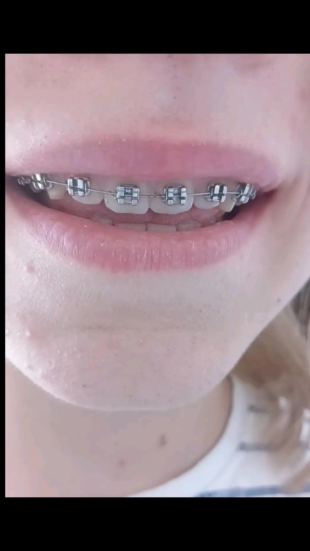 @Zahnspangen Club/  Braces Site