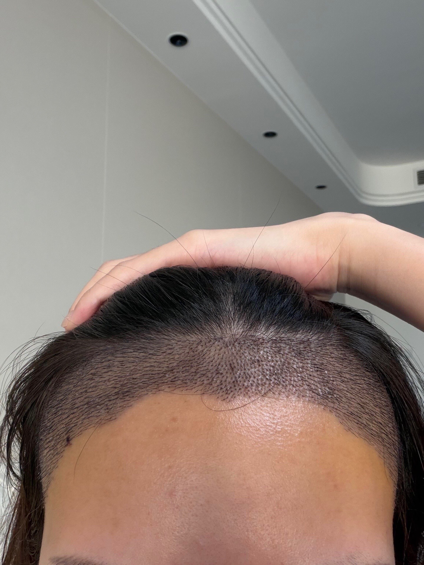 @HAIR TRANSPLANT WANG🇨🇳