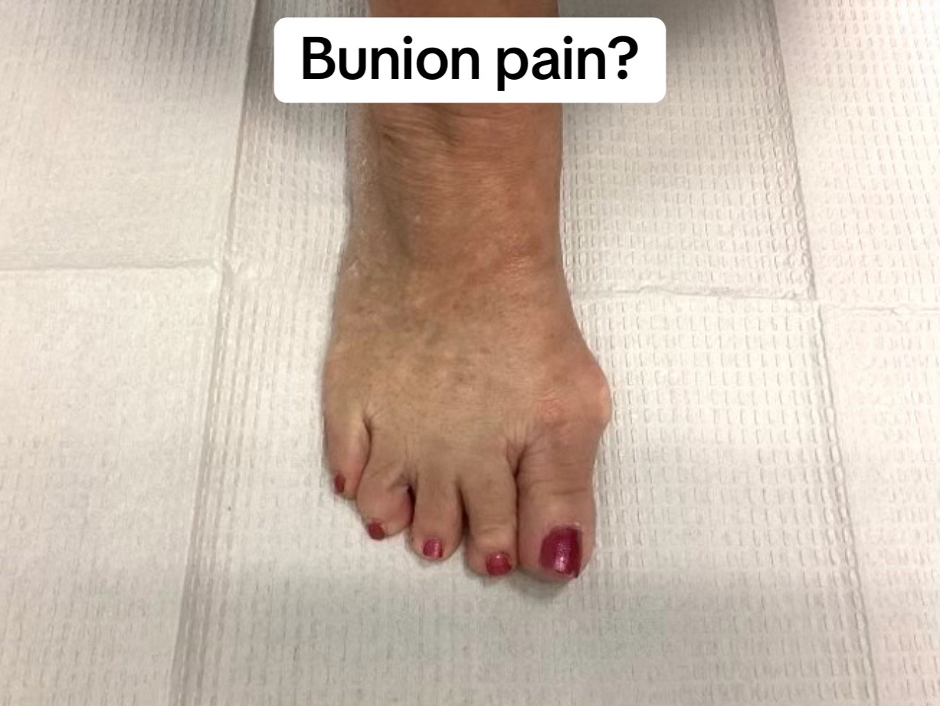 @The Bunion Boss