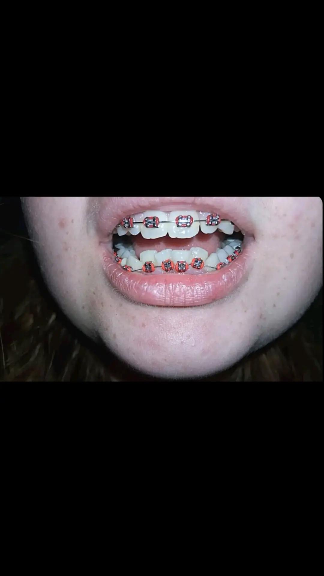 @Zahnspangen Club/  Braces Site