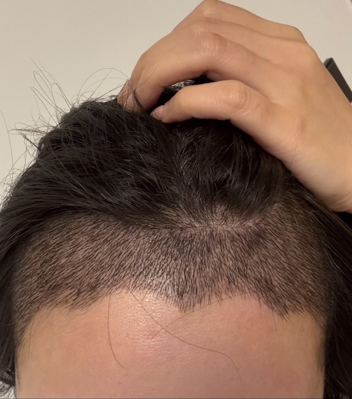 @HAIR TRANSPLANT WANG🇨🇳