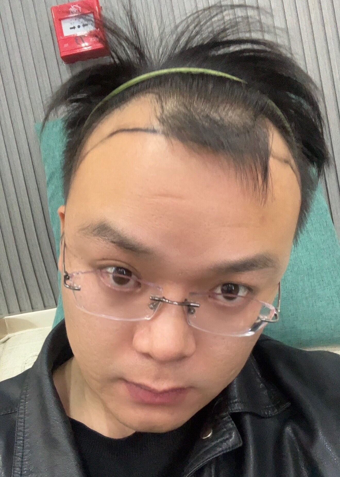 @HAIR TRANSPLANT WANG🇨🇳