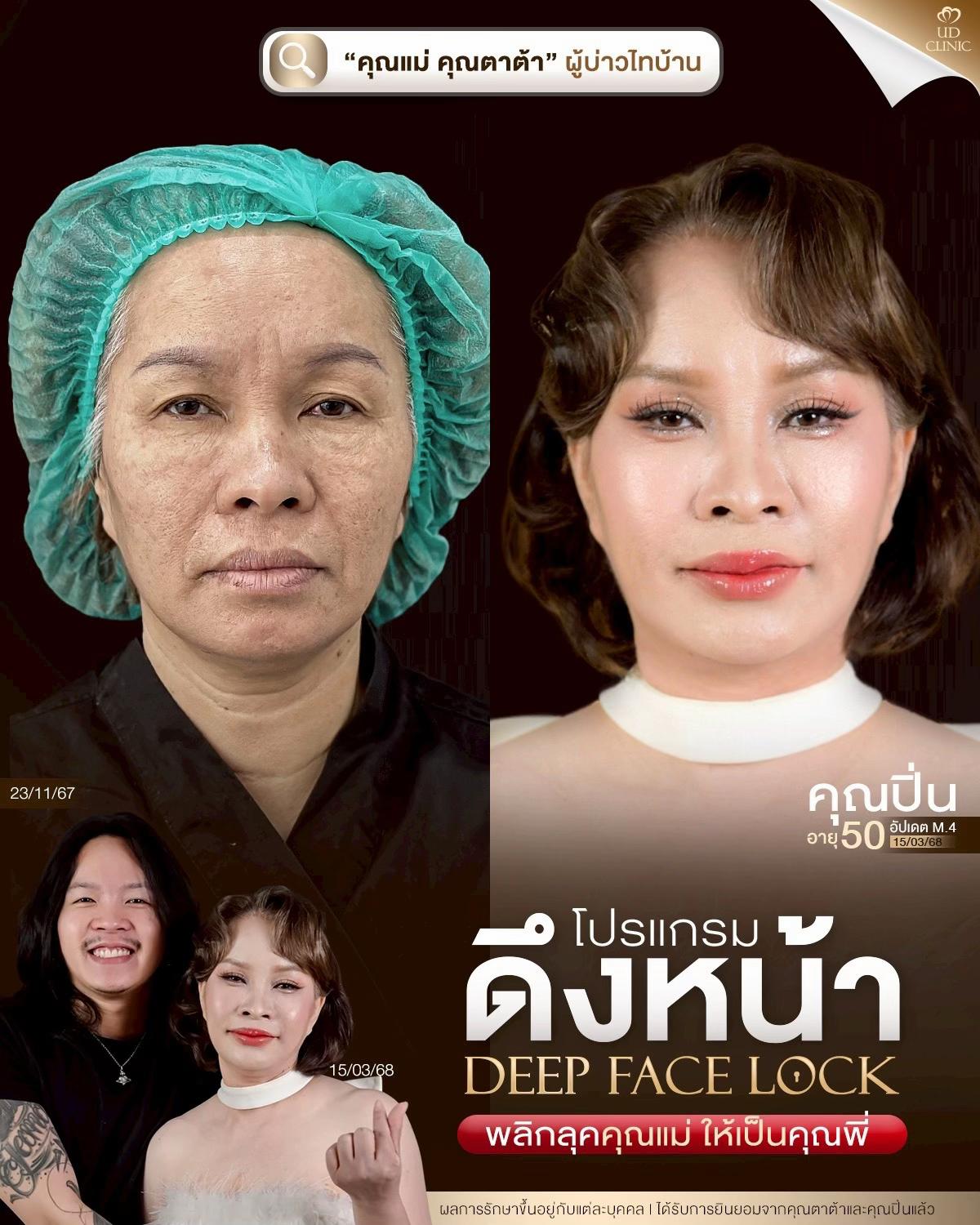 @ดึงหน้า ud clinic