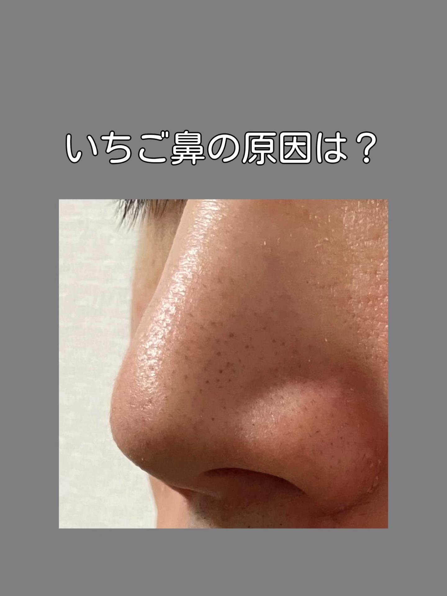 @メンズ脱毛サロンsilkymen’s札幌