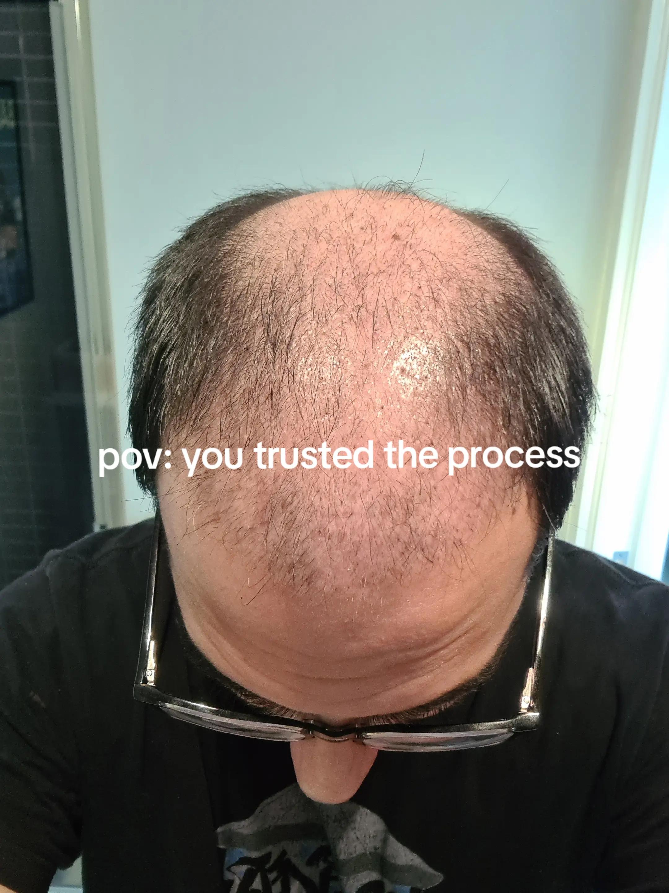@Amit | Hair Transplant Tips