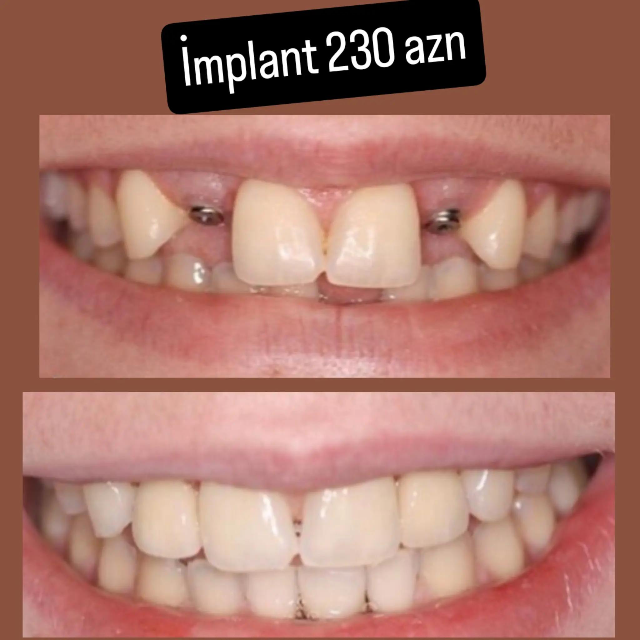 @implant.32