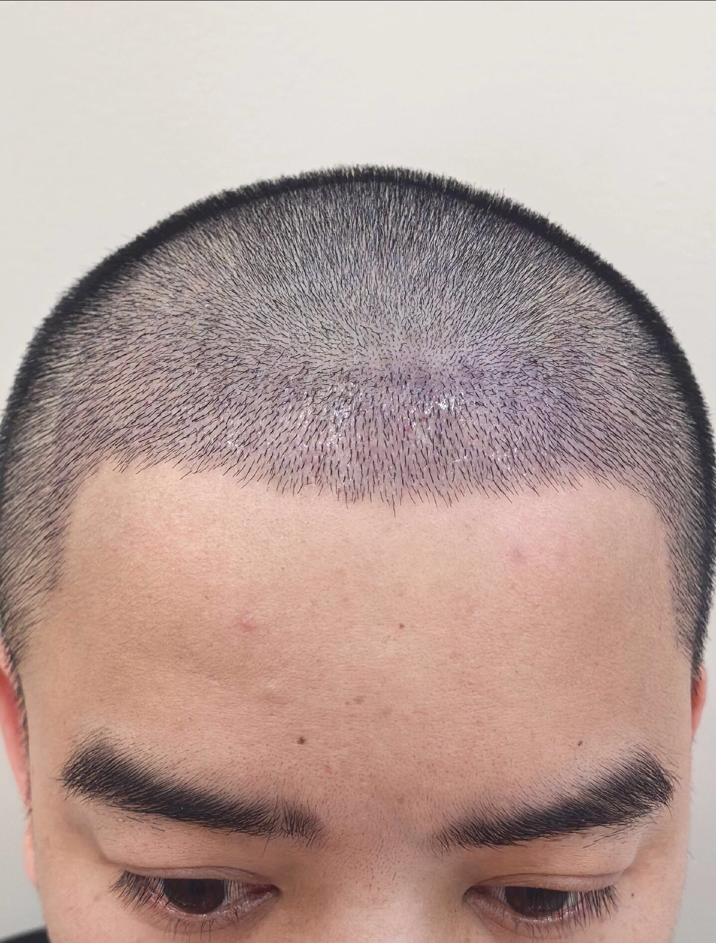 @HAIR TRANSPLANT WANG🇨🇳