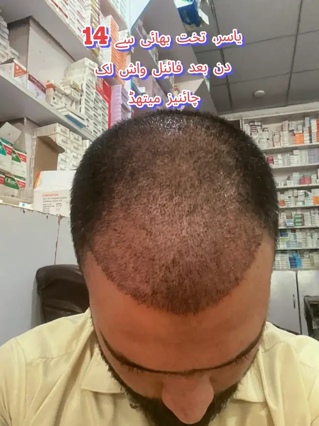 @Dr Asad shalman HairTransplant