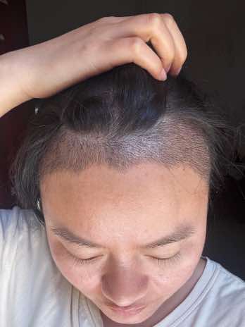 @HAIR TRANSPLANT WANG🇨🇳