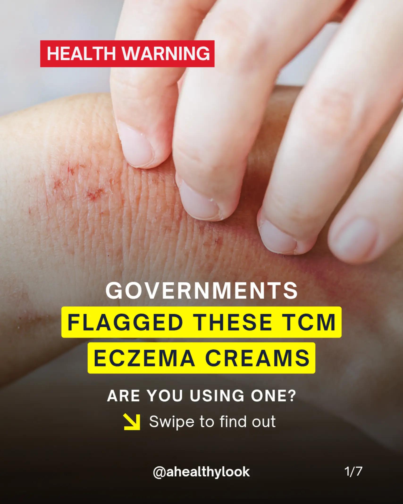 @Grace | TSW & Eczema Recovery