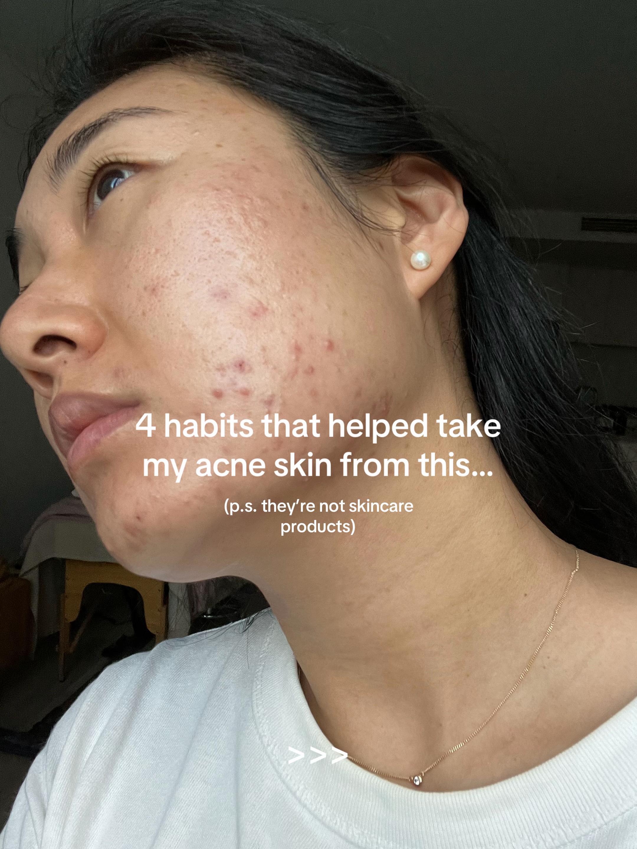 @Lisa | acne → clear skin